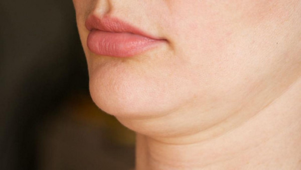 Double Chin